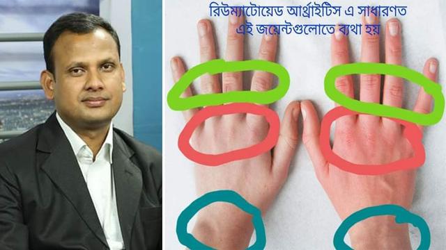 গেঁটে বাত নিয়ে সচেতনতা জরুরী